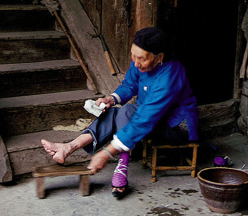 aftereffects of foot binding